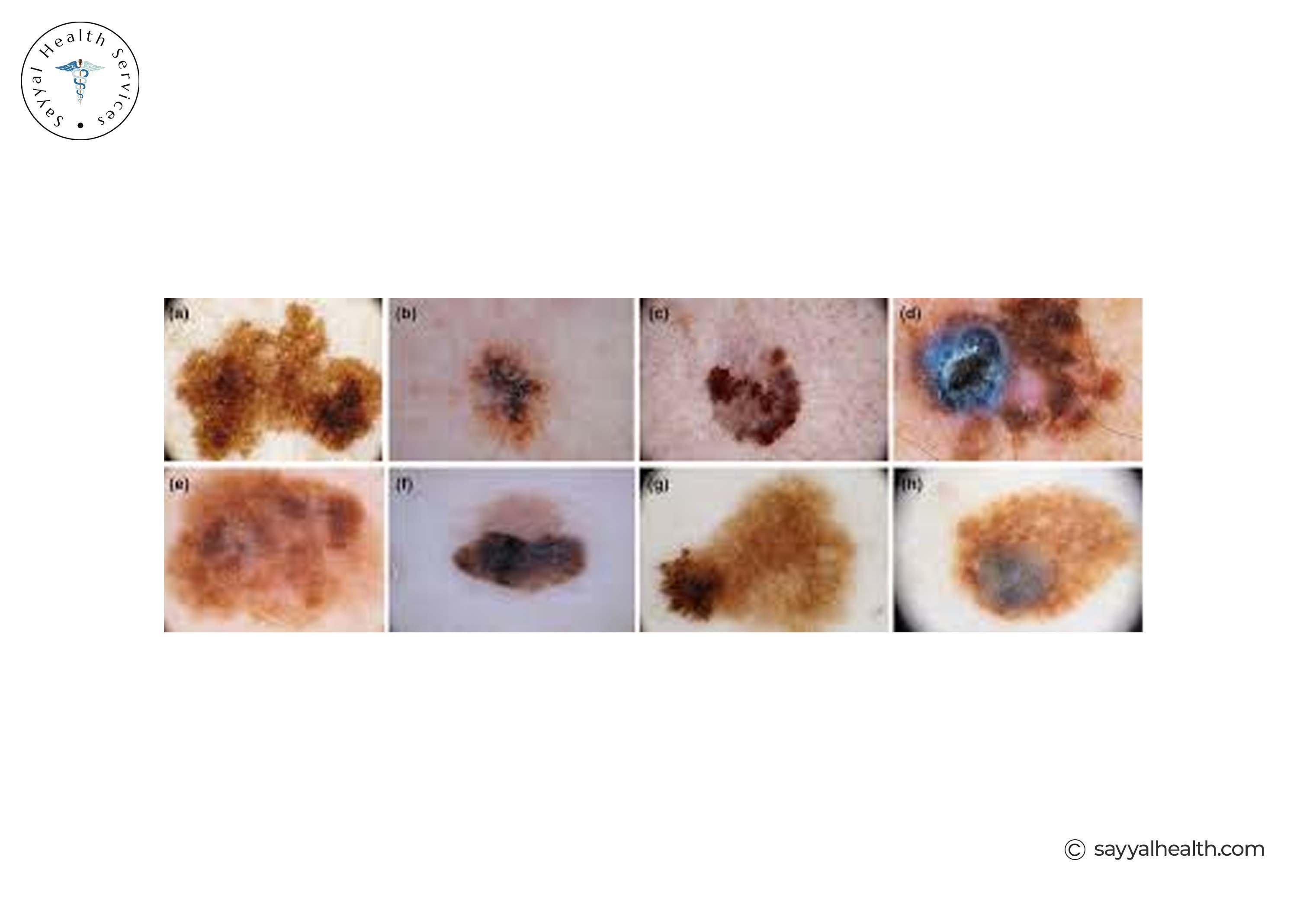 pictures of superficial spreading melanoma